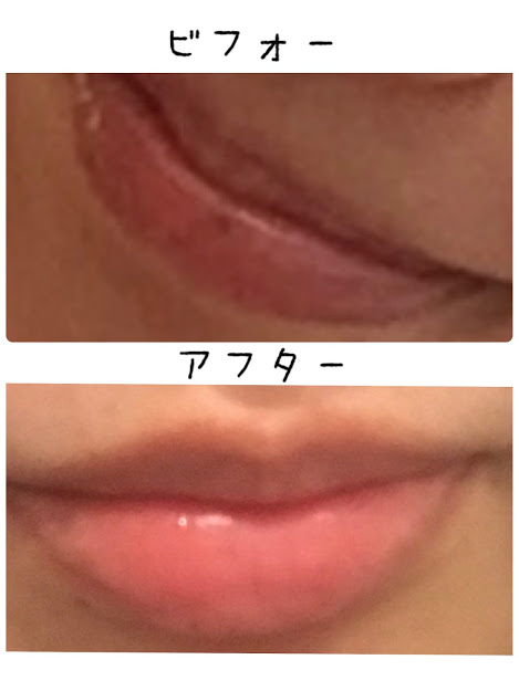 私が唇の黒ずみ 色素沈着 を治した方法 改善におすすめの市販リップ3選 メンタルポート